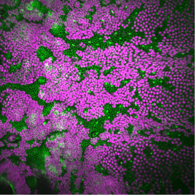 Como as células tumurais conquistam território?